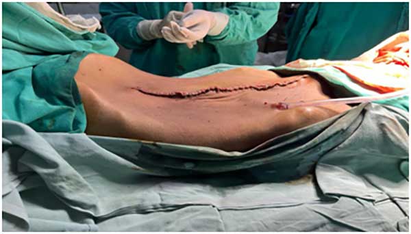 Doctors of GBP Hospital perform critical surgery, removes 11kg tumour