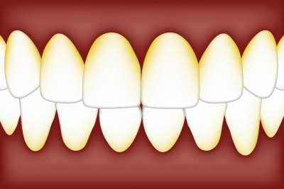 Measuring oral bacterial levels key to detect Alzheimer’s risk early: Study